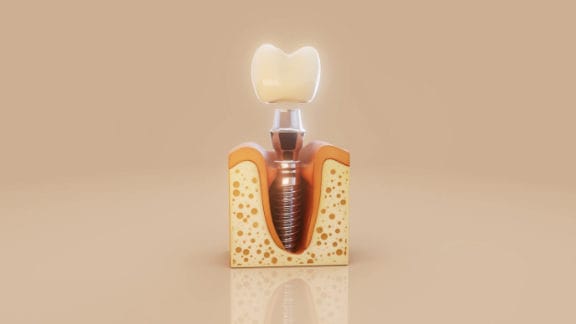 Rendering of a dental implant in the gums