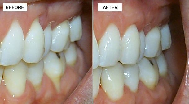 Before & After of Soft Tissue Grafting
